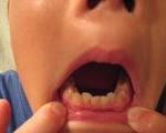 子供の歯の矯正。3ヶ月目